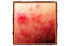 Eczema atopica descriere cauze tratament